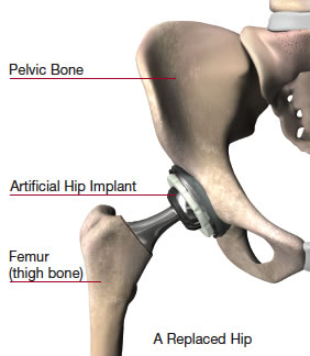 Everything You Need To Know About Minimally Invasive Total Hip